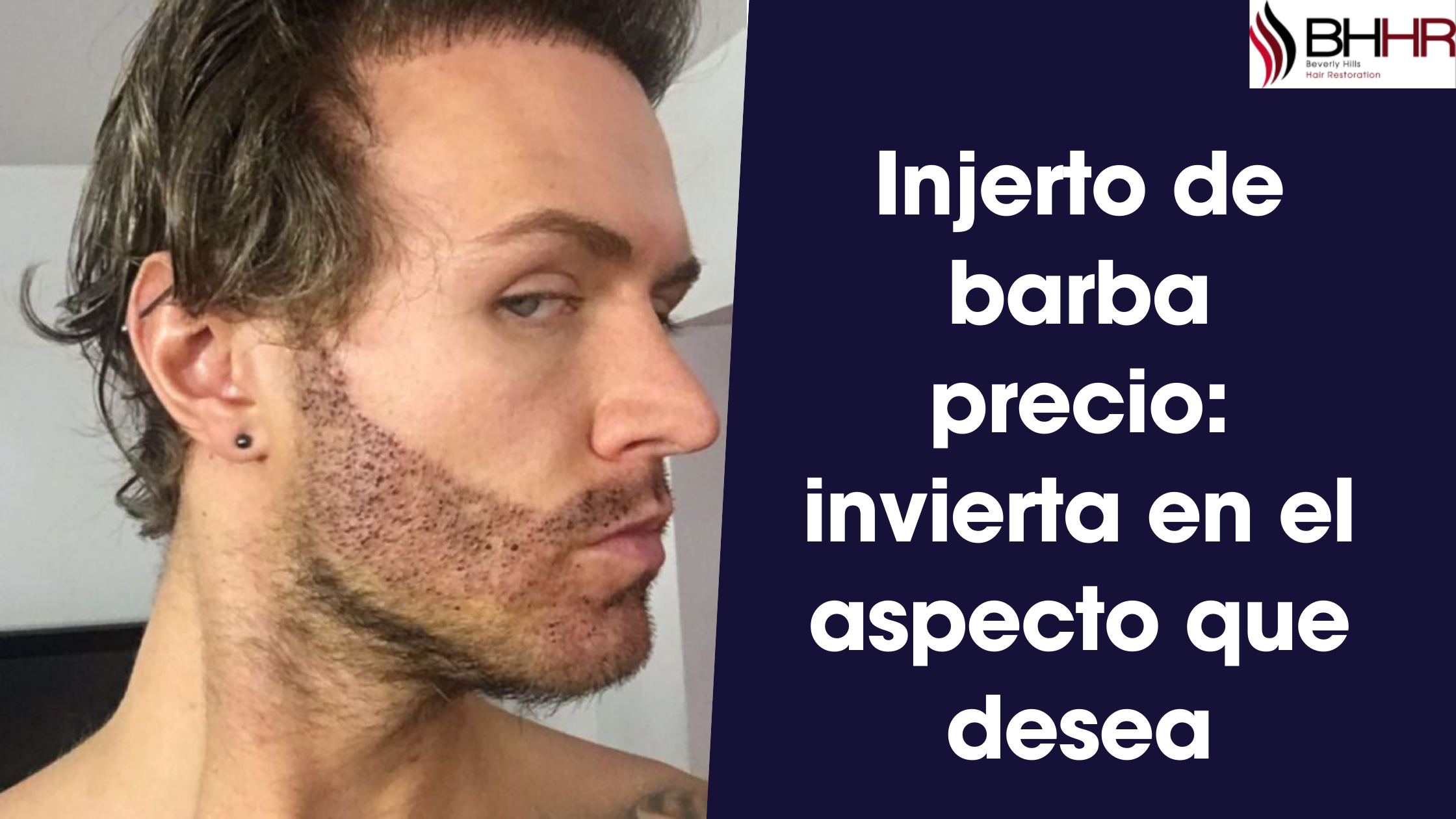 You are currently viewing Injerto de barba precio: invierta en el aspecto que desea